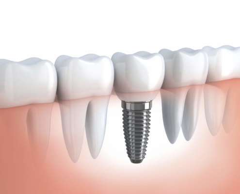 impianti dentali